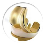 Gold Knee Replacement